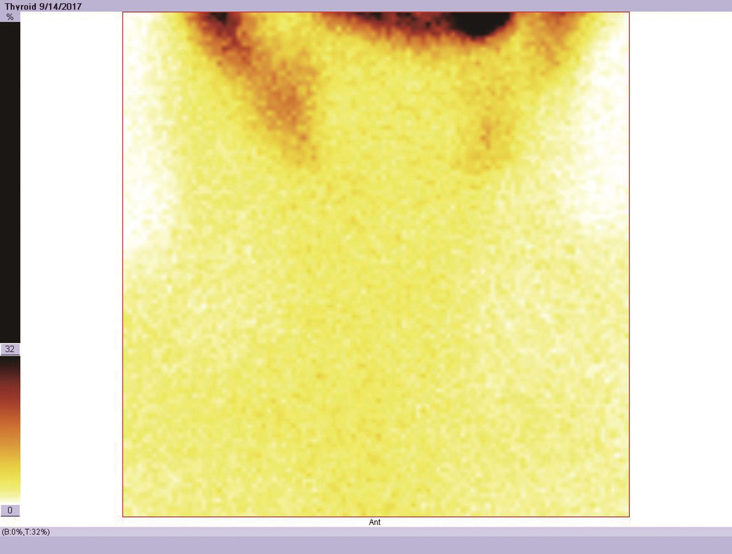 图15 甲状腺扫描（99mTc 5mCi）示甲状腺未见显影